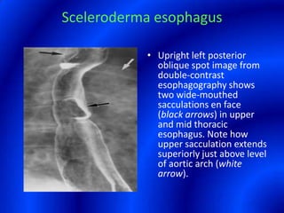 Sceleroderma esophagusUpright left posterior oblique spot image from double-contrast esophagography shows two wide-mouthed sacculations en face (black arrows) in upper and mid thoracic esophagus. Note how upper sacculation extends superiorly just above level of aortic arch (white arrow).