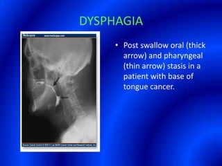 DYSPHAGIAPost swallow oral (thick arrow) and pharyngeal (thin arrow) stasis in a patient with base of tongue cancer.