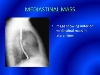 MEDIASTINAL MASSImage showing anterior mediastinal mass in lateral view.