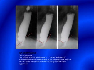 CA ESOPHAGUSWith shouldering The stenotic segment is long giving a “" *rat-tail” appearanceBarium swallow shows mild dilatation of the esophagus with irregular stenotic lesion in the lower end of the esophagus “moth eaten appearance