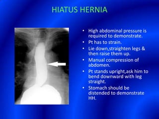 HIATUS HERNIAHigh abdominal pressure is required to demonstrate.Pt has to strain.Lie down,straighten legs & then raise them up.Manual compression of abdomen.Pt stands upright,ask him to bend downward with leg straight.Stomach should be distended to demonstrate HH.