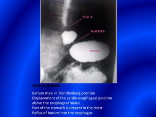HIATUS HERNIABarium meal in Trendlenberg position Displacement of the cardio-esophageal junction above the esophageal hiatus Part of the stomach is present in the chest Reflux of barium into the esophagus 