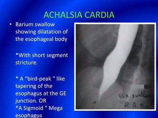 ACHALSIA CARDIABarium swallow showing dilatation of the esophageal body*With short segment stricture.* A “bird-peak " like tapering of the esophagus at the GE junction. OR*A Sigmoid “ Mega esophagus