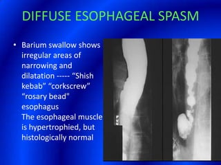 DIFFUSE ESOPHAGEAL SPASM Barium swallow shows irregular areas of narrowing and dilatation ----- “Shish kebab” “corkscrew” “rosary bead" esophagus The esophageal muscle is hypertrophied, but histologically normal 