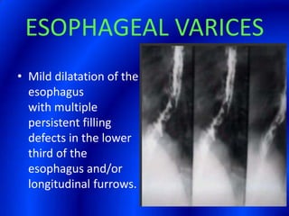ESOPHAGEAL VARICESMild dilatation of the esophagus with multiple persistent filling defects in the lower third of the esophagus and/or longitudinal furrows.