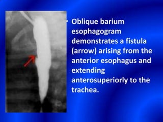 Oblique barium esophagogram demonstrates a fistula (arrow) arising from the anterior esophagus and extending anterosuperiorly to the trachea.