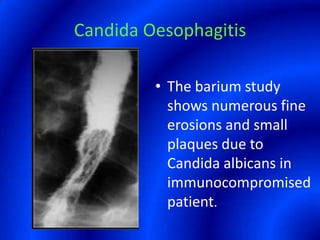 Candida OesophagitisThe barium study shows numerous fine erosions and small plaques due to Candida albicans in immunocompromised patient.