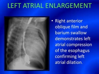 LEFT ATRIAL ENLARGEMENTRight anterior oblique film and barium swallow demonstrates left atrial compression of the esophagus confirming left atrial dilation.