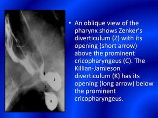 An oblique view of the pharynx shows Zenker's diverticulum (Z) with its opening (short arrow) above the prominent cricopharyngeus (C). The Killian-Jamieson diverticulum (K) has its opening (long arrow) below the prominent cricopharyngeus.