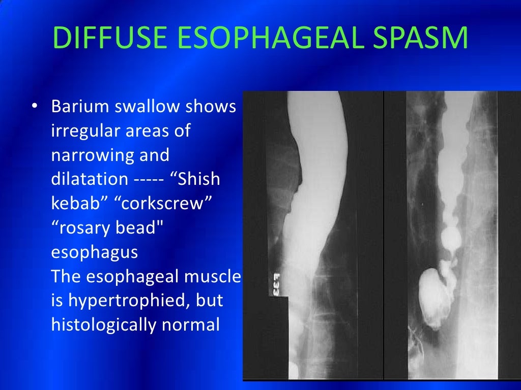 Barium Swallow Presentation