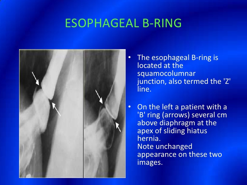 Barium Swallow Presentation