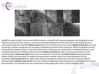 (A, B) The proximal right coronary artery (RCA) occlusion, visualized with separate antegrade and retrograde contrast
injections. Side branch–like, tortuous, continuous transseptal collaterals from the left anterior descending coronary
artery (LAD) supply the distal RCA (white arrow). Notice the mid-LAD severe focal stenosis (yellow arrow). (C) Lesion was
assumingly crossed by antegrade wire escalation, facilitated by proximal anchor technique. Notice the guidewire course
mimicking the imaginary contour of the native RCA artery. Crossing was not confirmed by contralateral injection, and 2
compliant balloons were inflated to dilate the lesion (white arrow). (D) Ellis type III coronary perforation into the
pericardial space (red arrow). (E) Delivery of the microcatheter to the distal cap (white arrow), following proximal
balloon inflation and placement of a pigtail pericardiocentesis catheter. Notice the ectopic guidewire into the
pericardium (red arrows). (F) Wire system externalization through the crossed lesion and the transiently deflated
proximal balloon (white arrow). (G, H) Final result. Sealing by deploying 2 drug-eluting stents, overlapping at the area of
the perforation. The mid-LAD lesion was treated with a drug-eluting stent with a similarly excellent result.
 