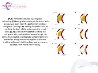(A, B) Perforation caused by antegrade
ballooning. (C) Retrograde crossing of the lesion with
a guidewire away from the perforation site (true
retrograde crossing). (D) Sealing the perforation by
crushing the body of the lesion onto the vessel
walls. (E, F) An alternative scenario, where the
retrograde wire navigated the lesion through the
connection created by antegrade ballooning (reverse
controlled antegrade and retrograde subintimal
tracking technique). In this unfavorable scenario, a
covered stent would be necessary.
 