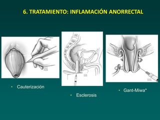 • Cauterización
• Esclerosis
• Gant-Miwa*
6. TRATAMIENTO: INFLAMACIÓN ANORRECTAL
 