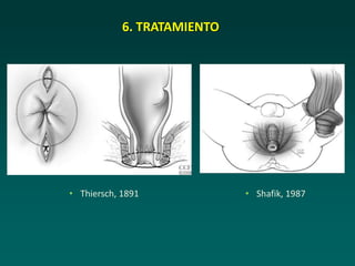 • Thiersch, 1891
6. TRATAMIENTO
• Shafik, 1987
 