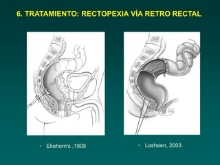• Ekehorn's ,1909
6. TRATAMIENTO: RECTOPEXIA VÍA RETRO RECTAL
• Lasheen, 2003
 