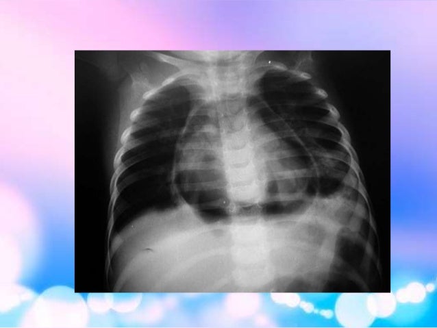 volutrauma vs barotrauma volutrauma vs barotrauma
