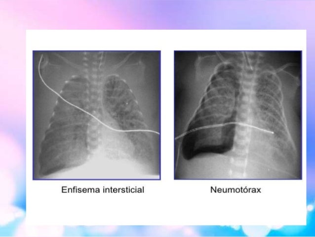 barotrauma vs volutrauma barotrauma vs volutrauma