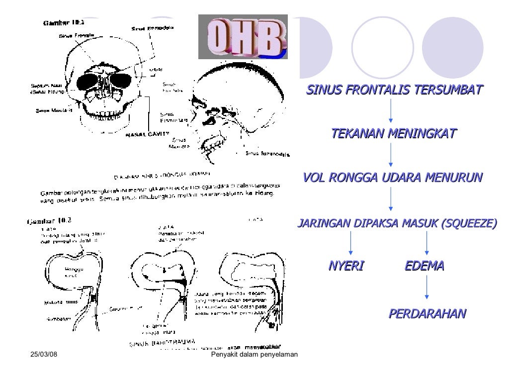 Barotrauma sinus
