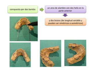 compuesto por dos bandas
un arco de alambre con dos helix en la
parte anterior
y dos brazos (de longitud variable y
pueden ser simétricos o asimétricos)
 