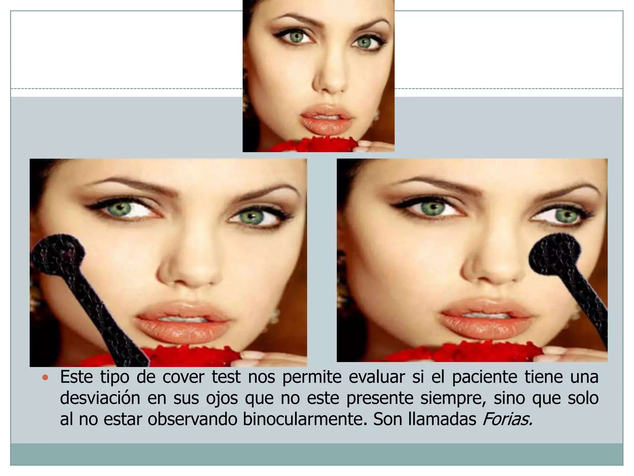 Cover Test Para Estrabismo | PPTX | Eye and Vision Conditions ...
