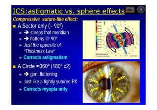 ICS:astigmatic vs. sphere effects
Compressive suture-like effect:
            suture-
   A Sector only (~ 90º)
                  (~
    ►   steeps that meridian
    ►  flattens @ 90º
    ► Just the opposite of
      “Thickness Law”
    ► Corrects astigmatism

   A Circle ≈360º (180º x2)
    ►   gen. flattening
    ► Just like a tightly sutured PK

    ► Corrects myopia only
 