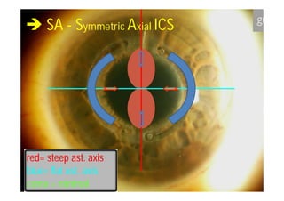  SA - Symmetric Axial ICS




red= steep ast. axis
            ast.
blue=
blue= flat ast. axis
           ast.
coma = minimal
 