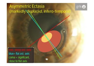 Asymmetric Ectasia
(markedly displaced, infero-temporal)




red= steep ast. axis
             ast.
blue=
blue= flat ast. axis
           ast.
coma = signficant,
         signficant,
close to flat axis
 