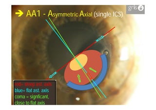  AA1 - Asymmetric Axial (single ICS)




red= steep ast. axis
             ast.
blue=
blue= flat ast. axis
           ast.
coma = signficant,
         signficant,
close to flat axis
 