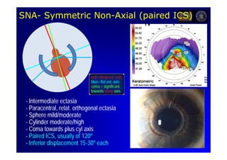 SNA-
SNA- Symmetric Non-Axial (paired ICS)
               Non-




                             red= steep ast. axis
                                         ast.
                             blue= ast.
                             blue= flat ast. axis
                             coma = significant,
                                      significant,
                             towards steep axis

 • Intermediate ectasia
 • Paracentral, relat. orthogonal ectasia
                  relat.
 • Sphere mild/moderate
            mild/
 • Cylinder moderate/high
             moderate/
 • Coma towards plus cyl axis
 • Paired ICS, usually of 120º
 • Inferior displacement 15-30º each
                          15-
 