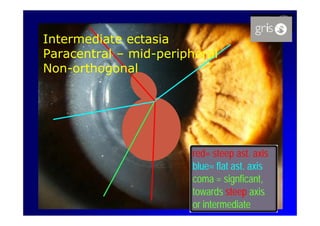 Intermediate ectasia
Paracentral – mid-peripheral
              mid-
Non-
Non-orthogonal




                       red= steep ast. axis
                                   ast.
                       blue=
                       blue= flat ast. axis
                                  ast.
                       coma = signficant,
                                signficant,
                       towards steep axis
                       or intermediate
 