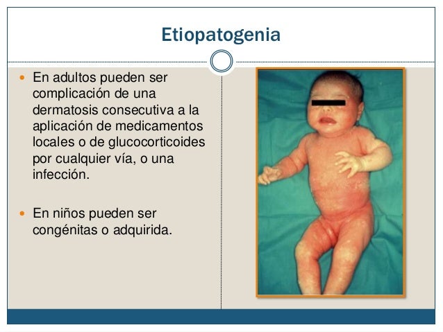 Los medios de la psoriasis de uña