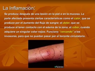 La Inflamación : Se produce después de una lesión en la piel o en la mucosa. La  parte afectada presenta ciertas características como el  calor , que se  produce por el aumento del flujo de sangre; el  dolor , que se  produce al tener contacto con el edema de la zona; el  rubor , cuando  adquiere un singular color rojizo. Funciona  “cercando”  a los  invasores, para que no puedan pasar por el torrente circulatorio. 