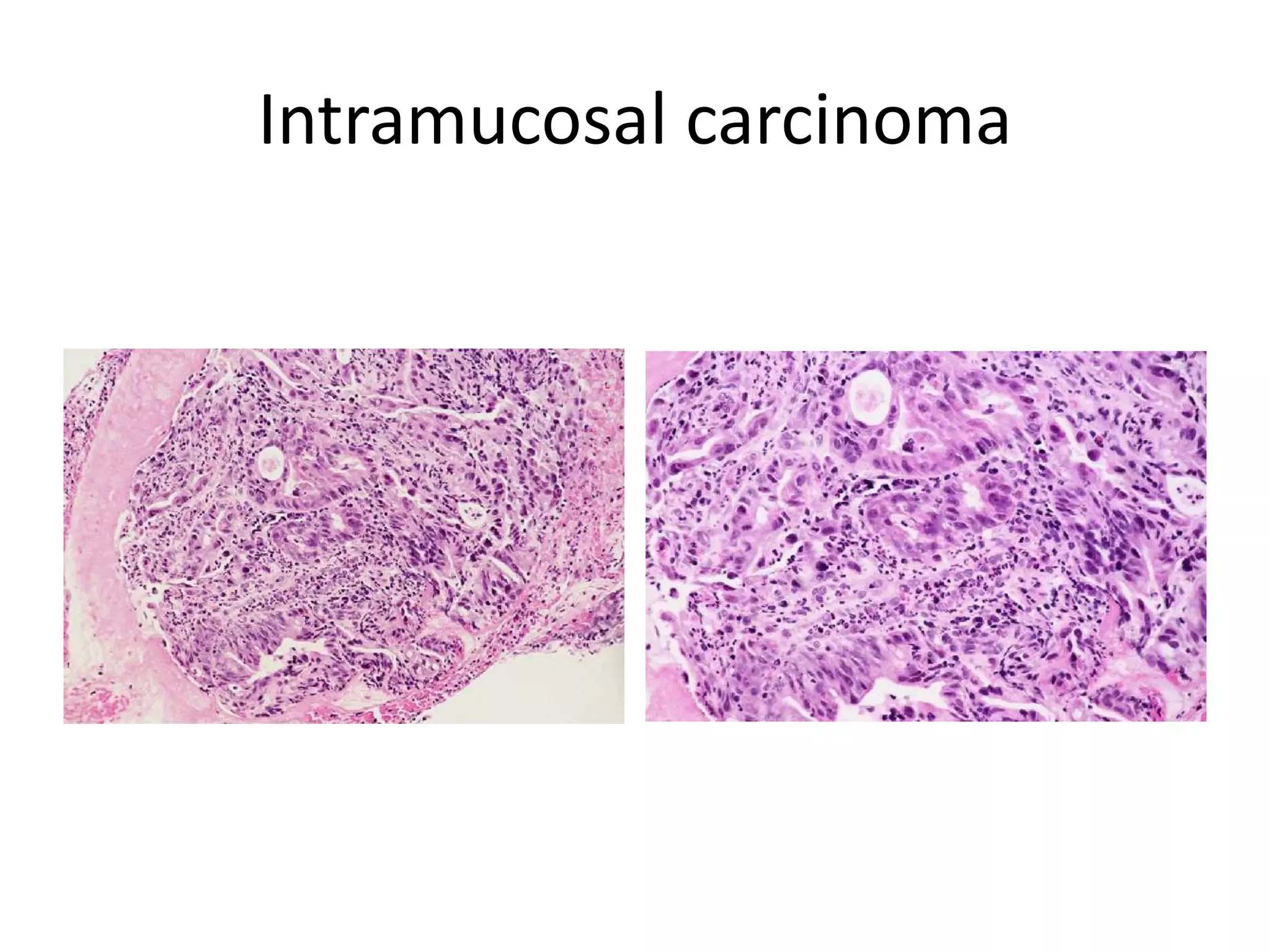 Barrett’s esophagus | PPTX