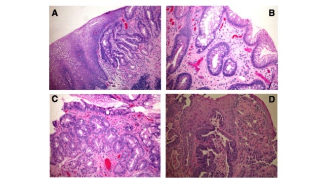 Barretts Esophagus, Barrett's Esophagus Hiatal Hernia, Barrett's Esop…