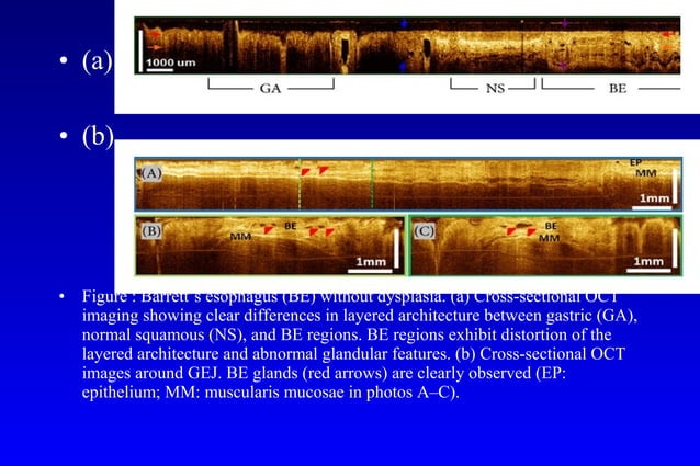 Barrett's esophagus; guidelines & new endoscopic techniques | PPT ...