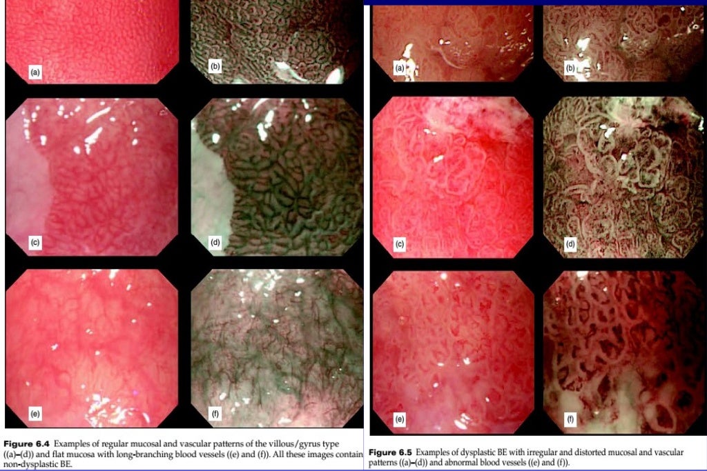 Barrett's esophagus; guidelines & new endoscopic techniques