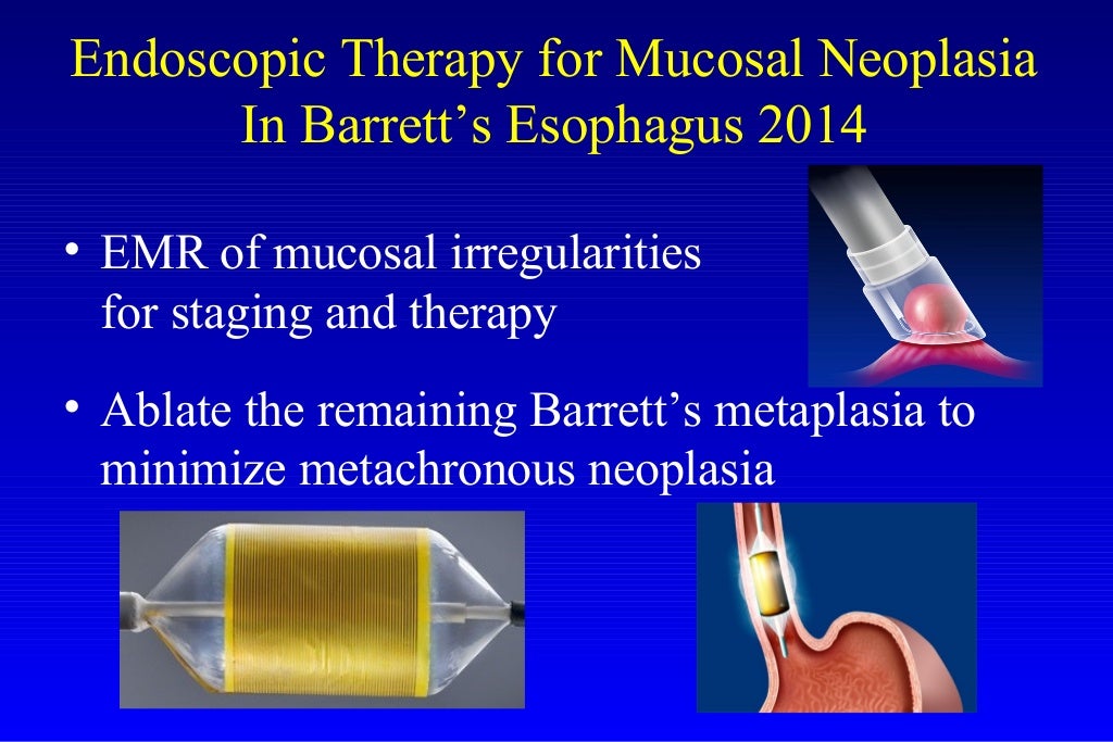 Barrett's esophagus; guidelines & new endoscopic techniques