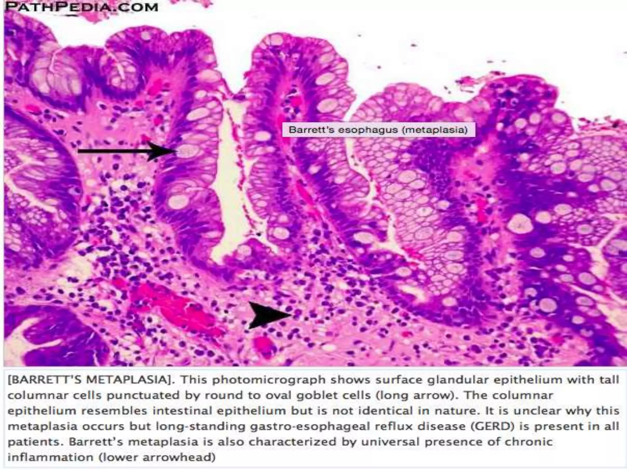 Barrett's Oesophagus for the Histopathologist.