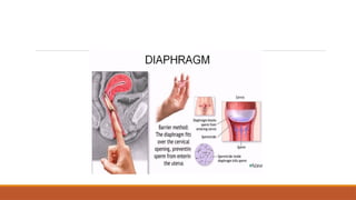 Comprehensive Overview of Barrier and Chemical Contraceptive Methods | PPTX