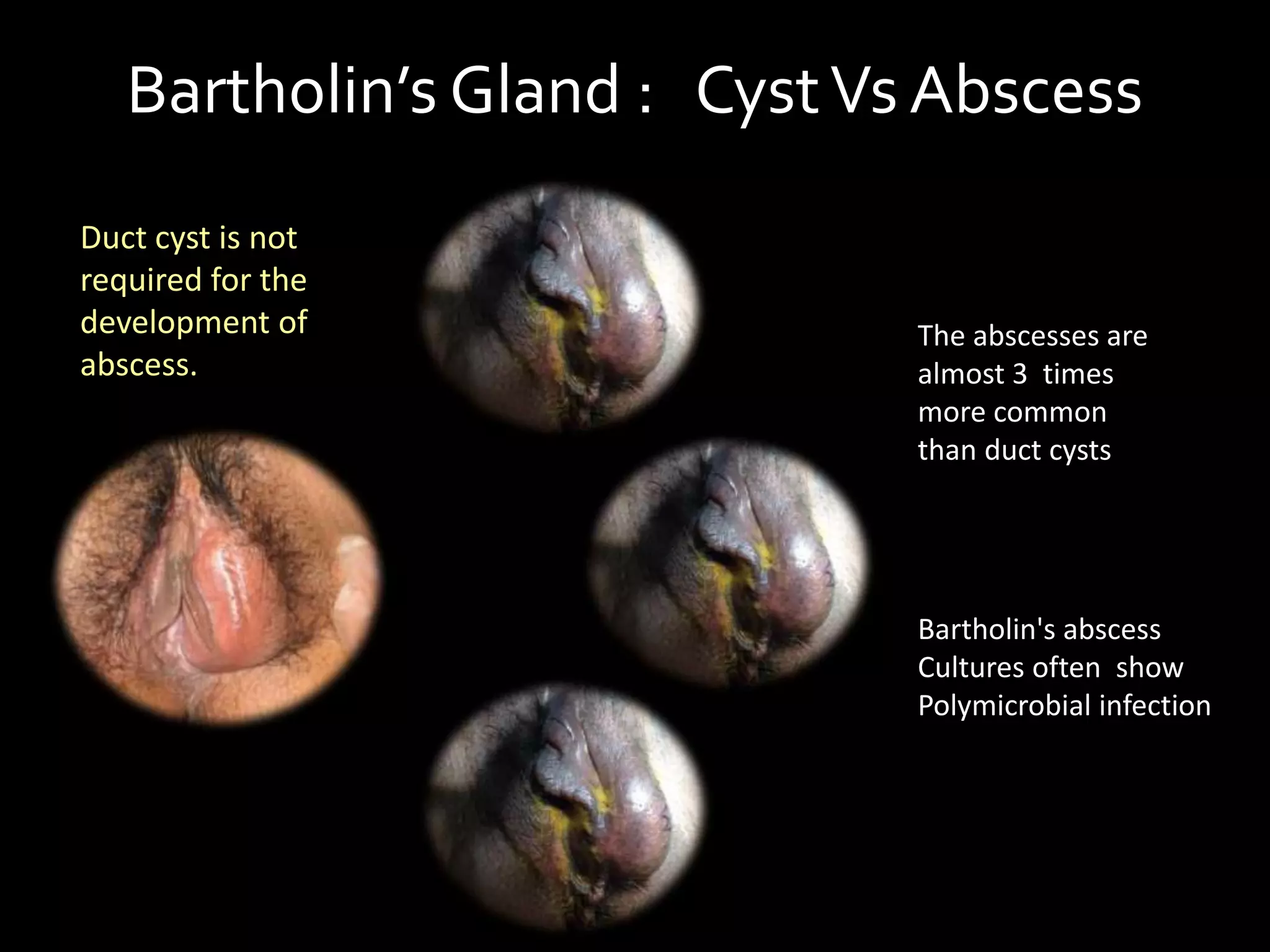 Bartholin gland cyst PPT
