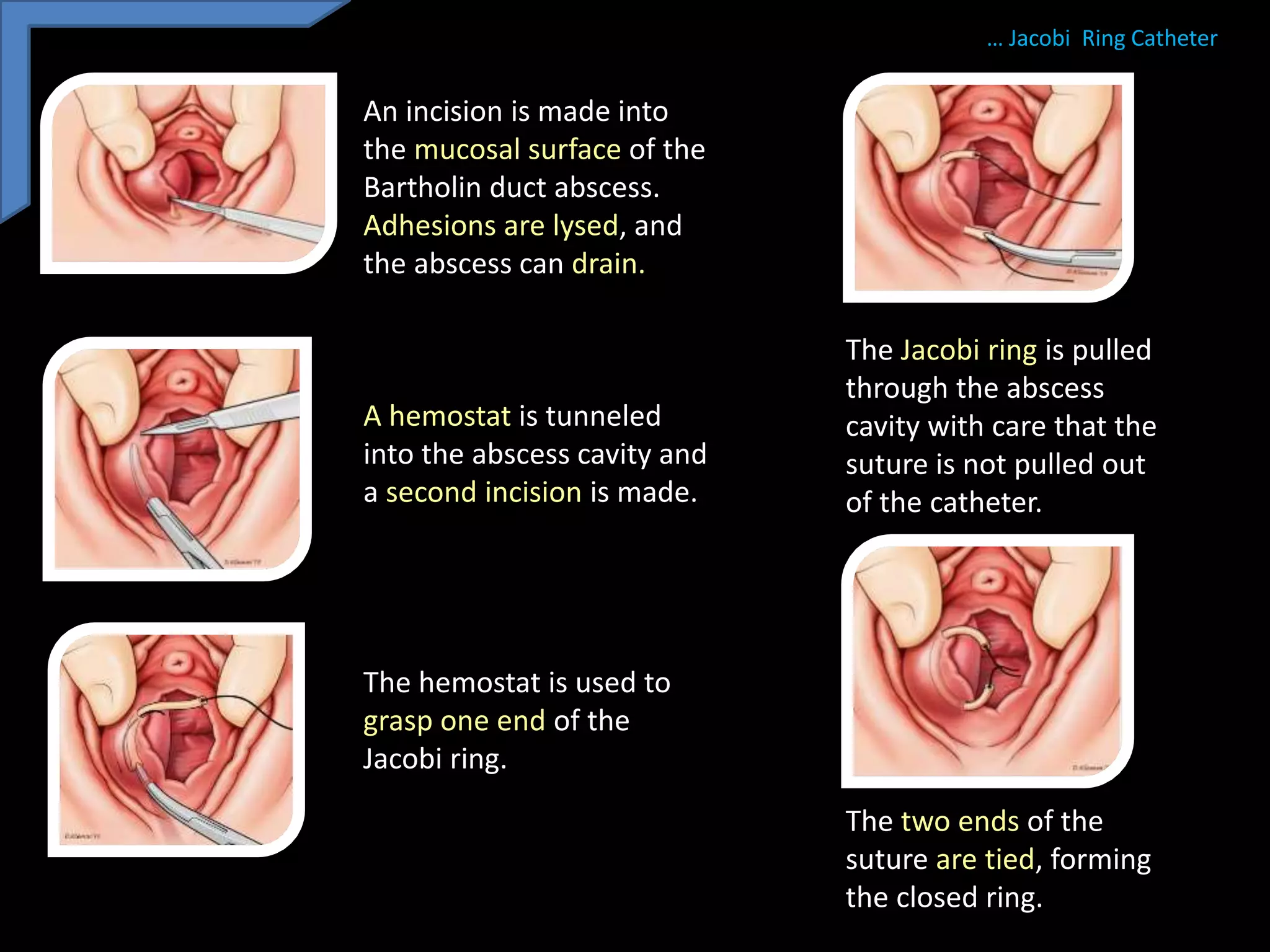 Bartholin gland cyst | PPTX