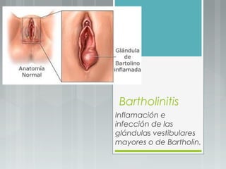 Bartholinitis
Inflamación e
infección de las
glándulas vestibulares
mayores o de Bartholin.
 