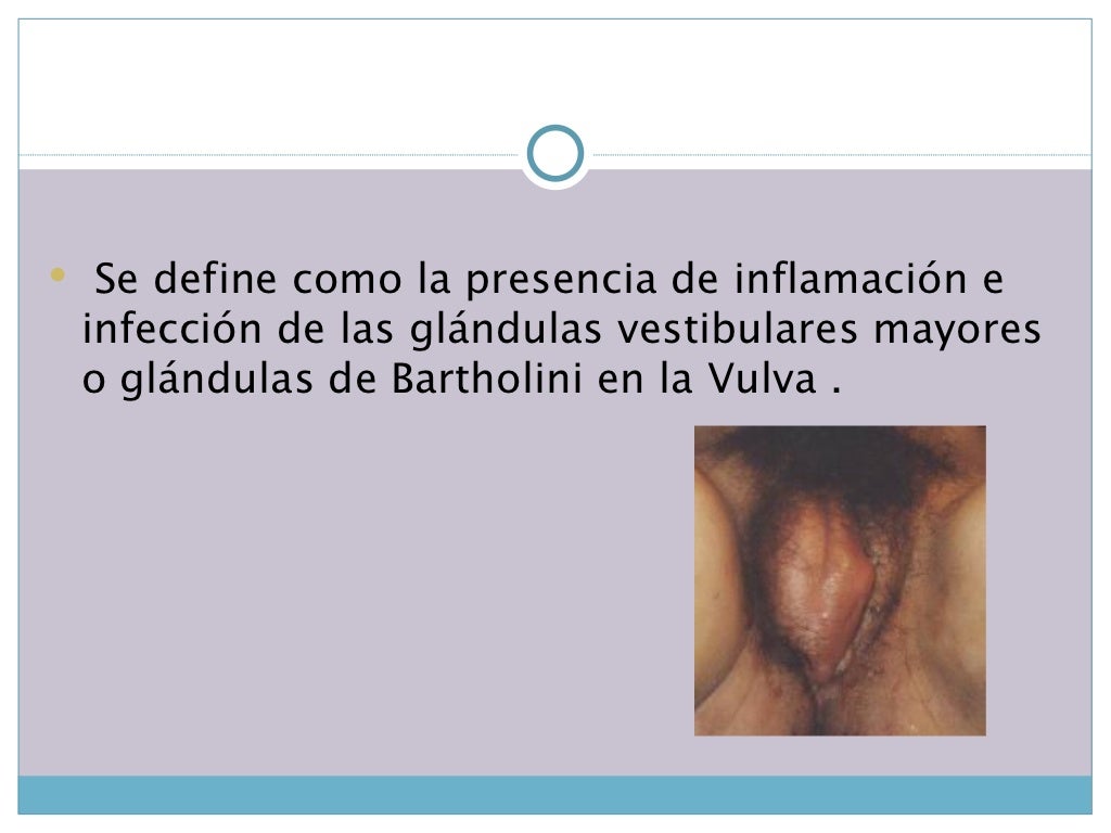 Bartolinitis Bartolinitis