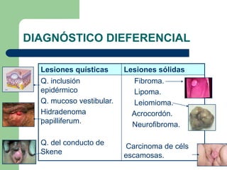 DIAGNÓSTICO DIEFERENCIAL
Lesiones quísticas Lesiones sólidas
Q. inclusión
epidérmico
Q. mucoso vestibular.
Hidradenoma
papilliferum.
Q. del conducto de
Skene
Fibroma.
Lipoma.
Leiomioma.
Acrocordón.
Neurofibroma.
Carcinoma de céls
escamosas.
 