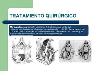 TRATAMIENTO QUIRÚRGICO
Marsupialización: incisión vertical de 1,5 a 3 cm en el centro del
quiste,produciéndose así el drenaje espontáneo del contenido. Lavar la cavidad
con suero salino y romper las bridas que existan. Se evierten las paredes y se
suturan a la mucosa vestibular con sutura reabsorbible.
 