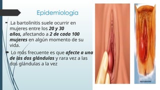 Comprehensive Overview of Acute Bartolinitis: Diagnosis and Treatment ...