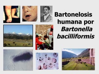Bartonelosis   humana por Bartonella  bacilliformis 