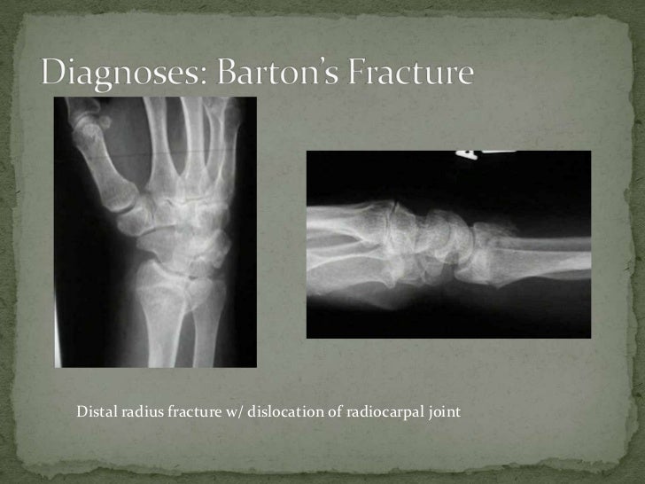 Barton’s fracture