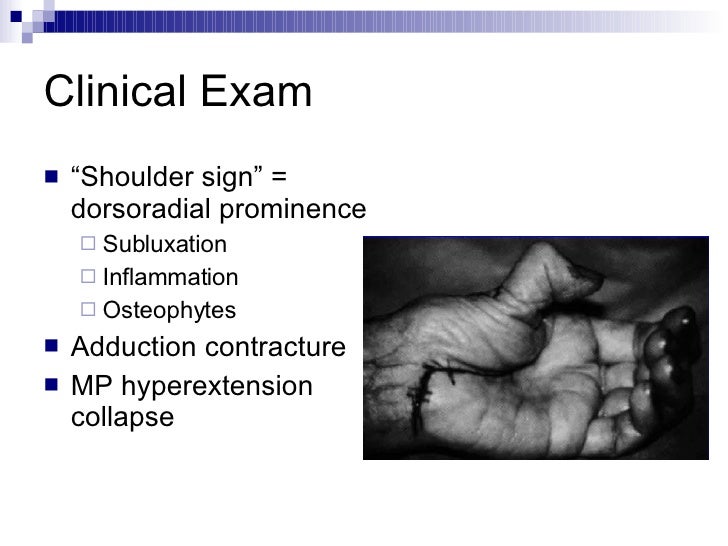 Basal Joint Arthritis Of The Thumb